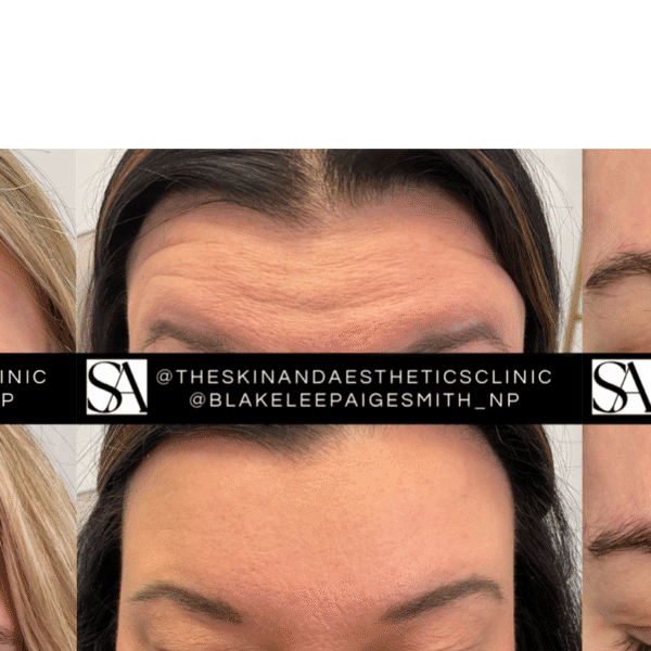 Botox before and after results showcasing smoother, youthful skin in Upper Cumberland.